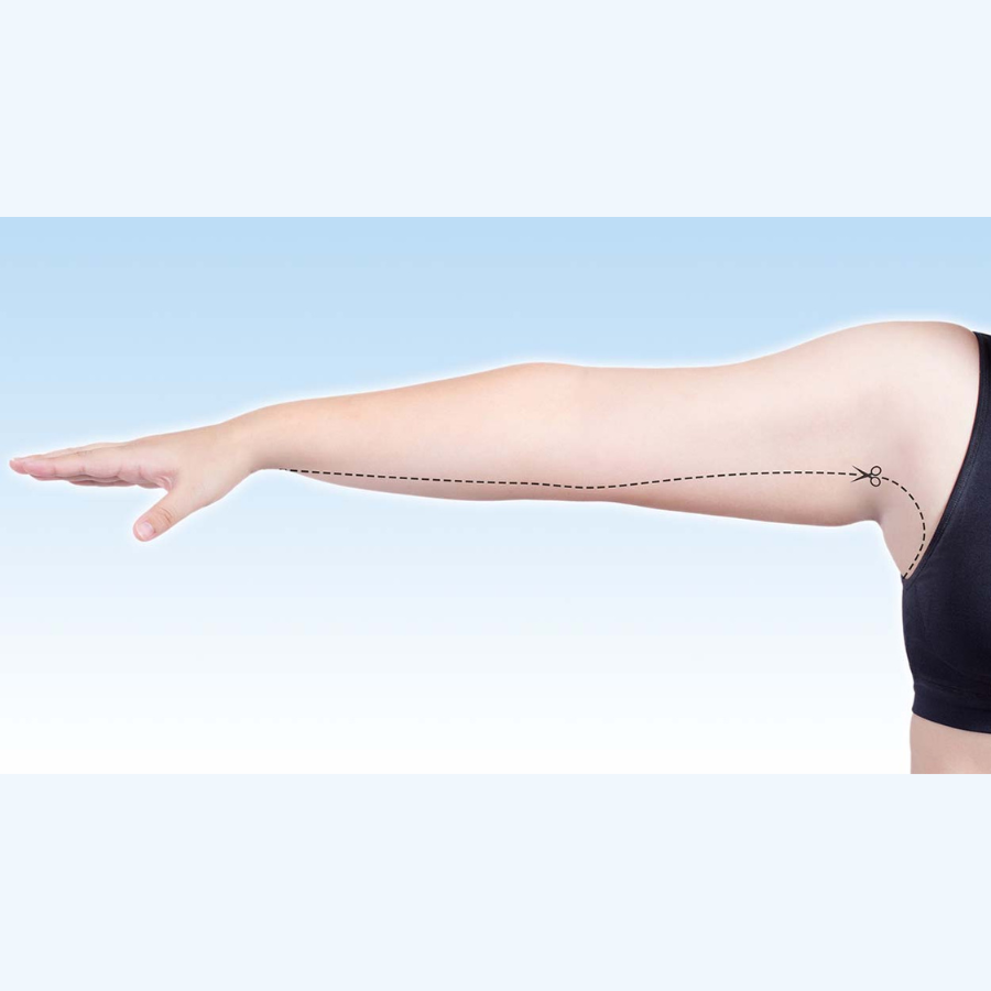 Contour of Arms, Thighs or Back