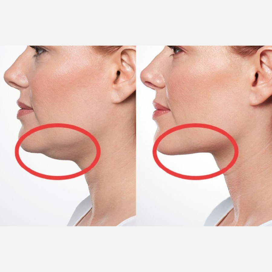 Double Chin Treatment & Jaw Contour